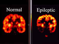 cerebro-ataque-epilepsia