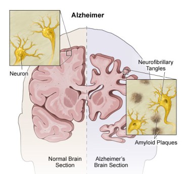 alzheimers-diagram-brain2