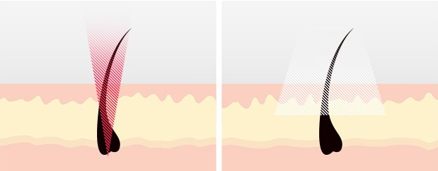 02_FG_IPLorLASER_Laser-vs-IPL