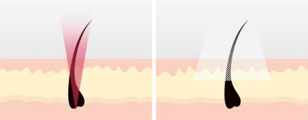 02_FG_IPLorLASER_Laser-vs-IPL